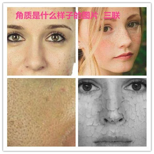 什么是角质？角质长什么样图片公布