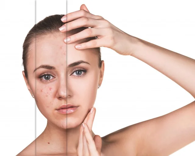 额头和眉心长痘痘的三大原因