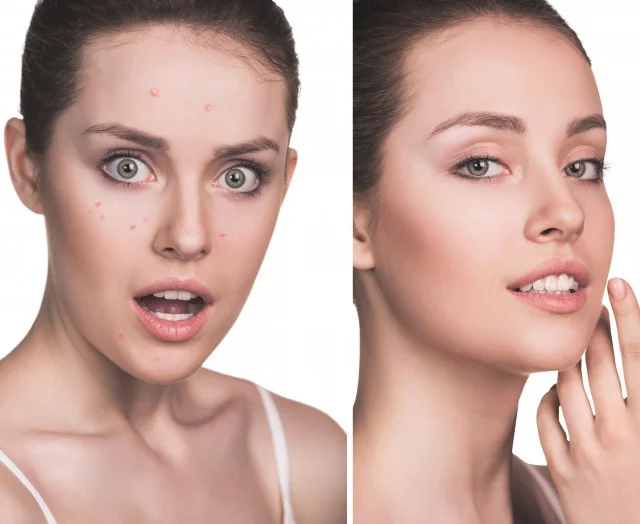 额头和眉心长痘痘的三大原因