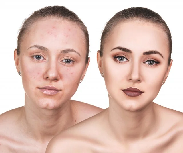 额头和眉心长痘痘的三大原因