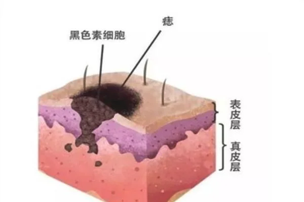 做点痣需要多长时间？全过程解析