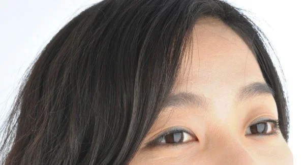 做内窥镜除皱去鱼尾纹的流程是什么？恢复时间要多久？