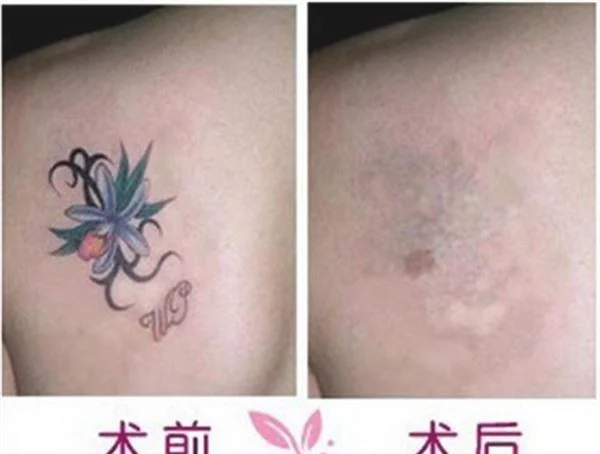 做皮肤磨削去纹身的流程是什么？恢复时间要多久？