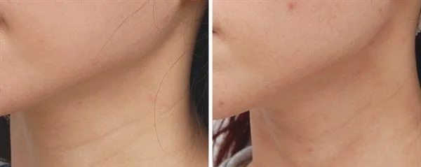 做去颈纹失败修复的流程是什么?恢复时间要多久?