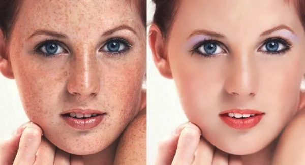 做激光去雀斑需要多少钱？费用是多少？