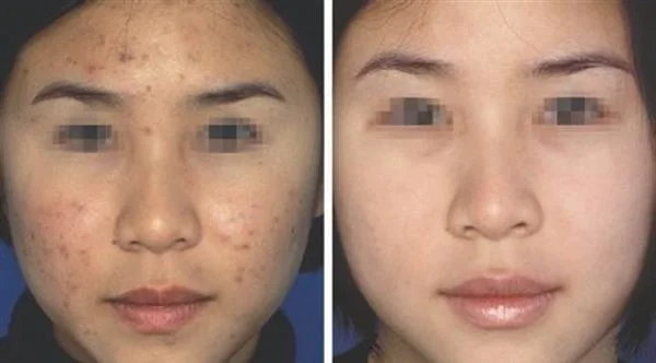 做针清去青春痘的流程是什么？恢复时间要多久？