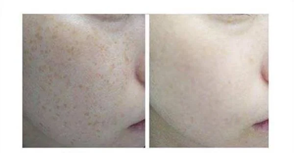 做彩光祛斑需要多长时间?全过程解析