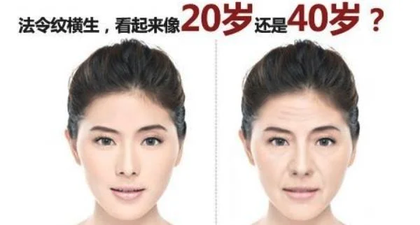 做激光去法令纹的步骤及注意事项