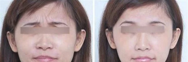 做脉冲光去眉间纹需要多长时间？全过程解析