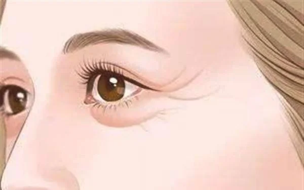 做玻尿酸去鱼尾纹禁忌人群及适宜人群有哪些?