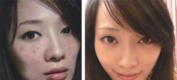 做光子去痘印治疗效果怎么样？效果保持时间多久？