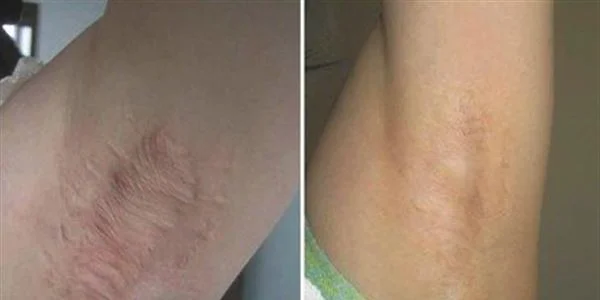 疤痕增生修复有哪些优点?