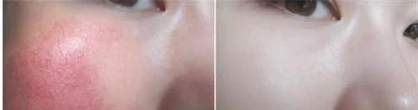 做E光去红血丝价格贵不贵
