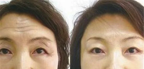 激光去除抬头纹优点是什么？