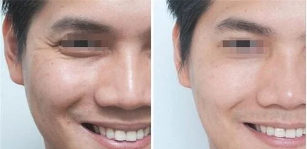 做脉冲光去鱼尾纹价格