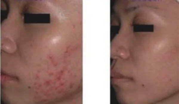 做果酸换肤袪痘疤价格要多少