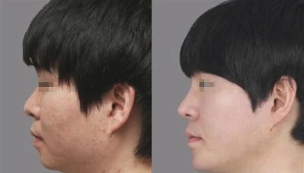 做去痘疤手术多少钱？