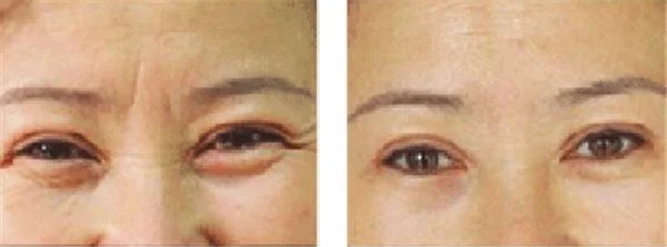 做射频微针去眉间纹价格