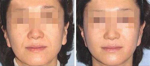 做激光去法令纹治疗效果怎么样?效果保持时间多久?