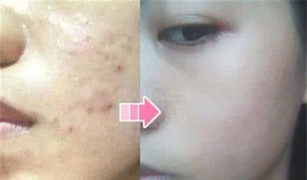 做祛痘印治疗效果怎么样？效果保持时间多久？
