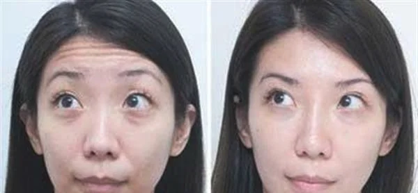 做光子除抬头纹多少钱