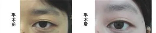 做冷冻去除太田痣手术多少钱？