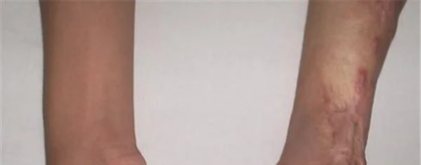 烫伤疤痕修复恢复需要注意什么?