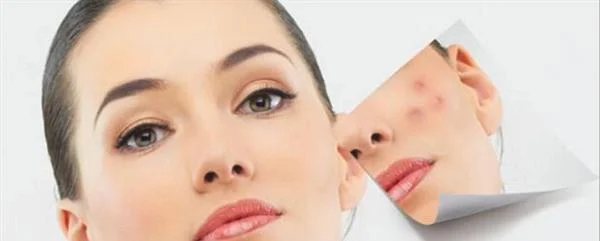 做E光祛痘费用大概需要多少