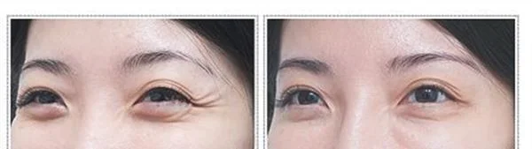 去眼角细纹手术安全吗？