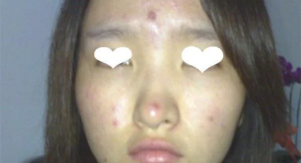 做果酸焕肤祛痘印手术注意事项是什么？