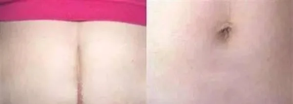 做剖腹产疤痕修复多少钱