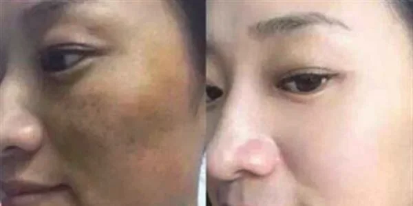 激光祛斑效果彻底吗