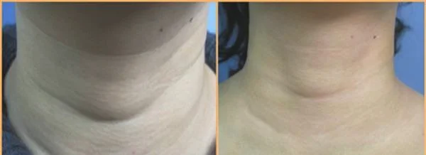 做玻尿酸除颈纹价格