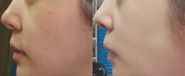 水光娃娃手术注意事项是什么？