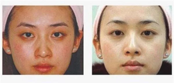 果酸换肤去眼角细纹效果如何？