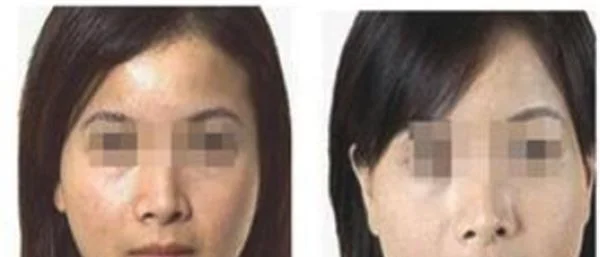 做自体脂肪去痘疤价格多少钱