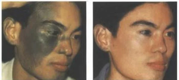 做光子治疗太田痣多少钱