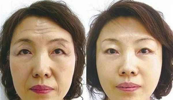 做射频去抬头纹价格贵不贵