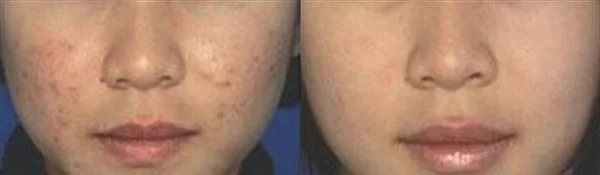 做E光祛痘治疗效果怎么样?效果保持时间多久?