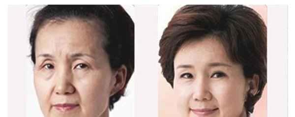 射频微针去眉间纹不适合哪种人？