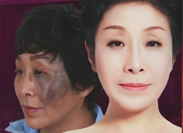 做去太田痣失败修复价格