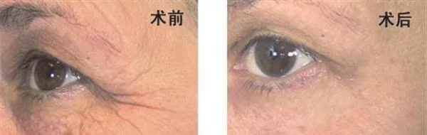 射频去鱼尾纹手术注意事项是什么？