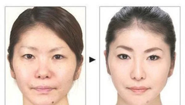 做光子点痣价格