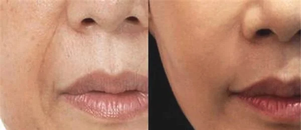 做爱贝芙去法令纹价格