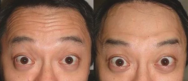 做额颞部除皱去抬头纹多少钱