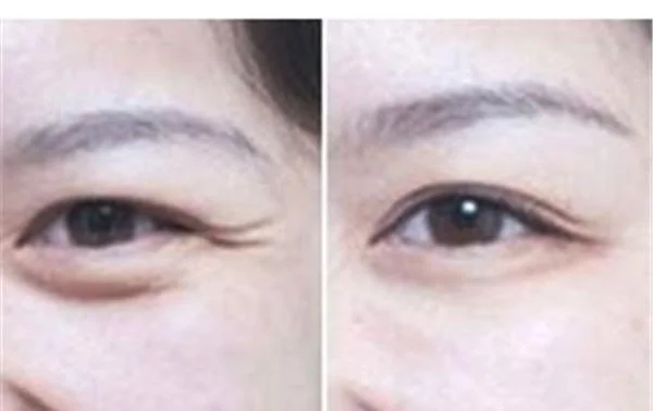 小切口除皱去鱼尾纹要多少钱？
