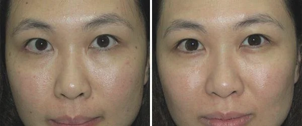 做光子美白治疗效果怎么样？效果保持时间多久？