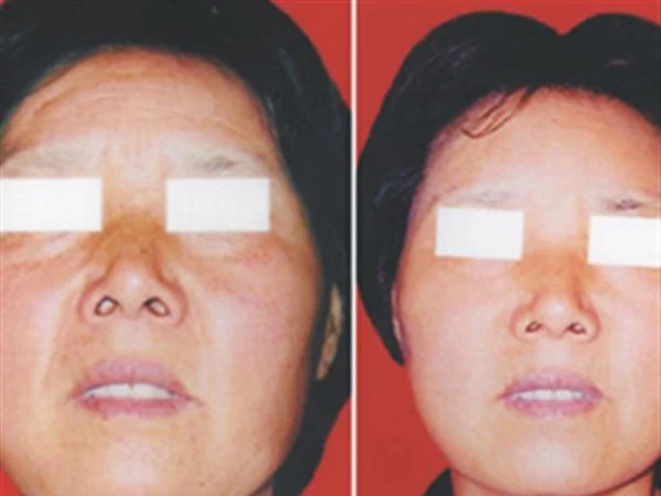 去抬头纹失败修复需要怎么护理？