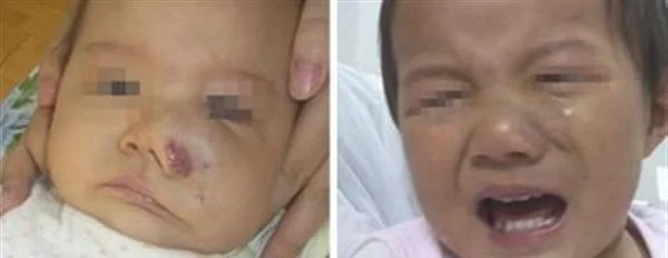 光子治疗血管瘤手术术后护理？