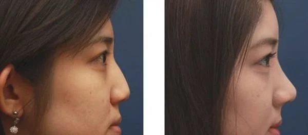 祛痘手术术后护理？